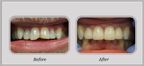 Before and After Dental Treatment