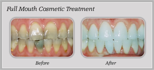 Before and After Dental Treatment