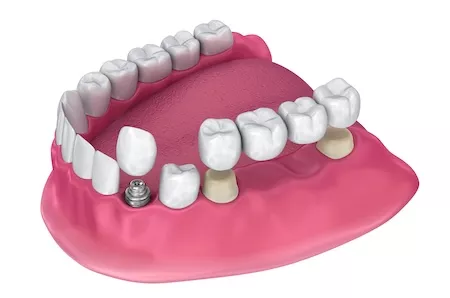 Dental Crowns and Bridges