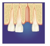 Bone Grafting
